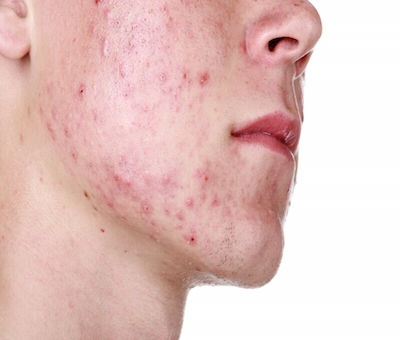 Rimedi contro l’acne: prevenzione e cura - Articoli & News - Farmabeauty